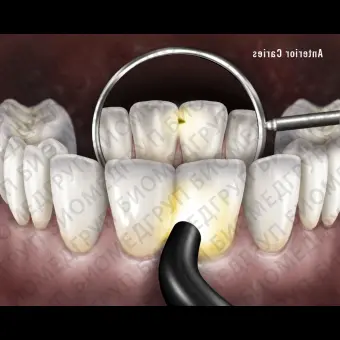 Детектор кариеса диафаноскопией Microlux