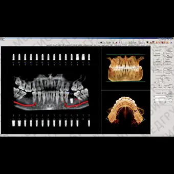 Программное обеспечение для обработки снимков зубов Invivo 6