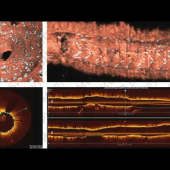Программное обеспечение для исследования сосудов CAAS IVUS OCT