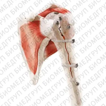 Ортопедическая проволока для контроля протеза бедра Strapflex