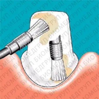 Sonicflex clean brush 4  насадкащетка конус большой для чистки зубов
