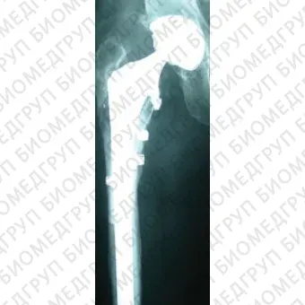 Ортопедическая проволока для контроля протеза бедра SuperCable